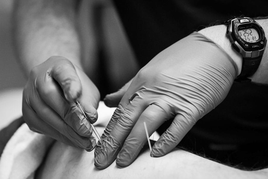 close up images of medical close assessing acupuncture treatment at physical therapy office black and white image by danielle jacqueline photography for businesses